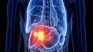 লিভারের সমস্যা। প্রতীকী ছবি। 