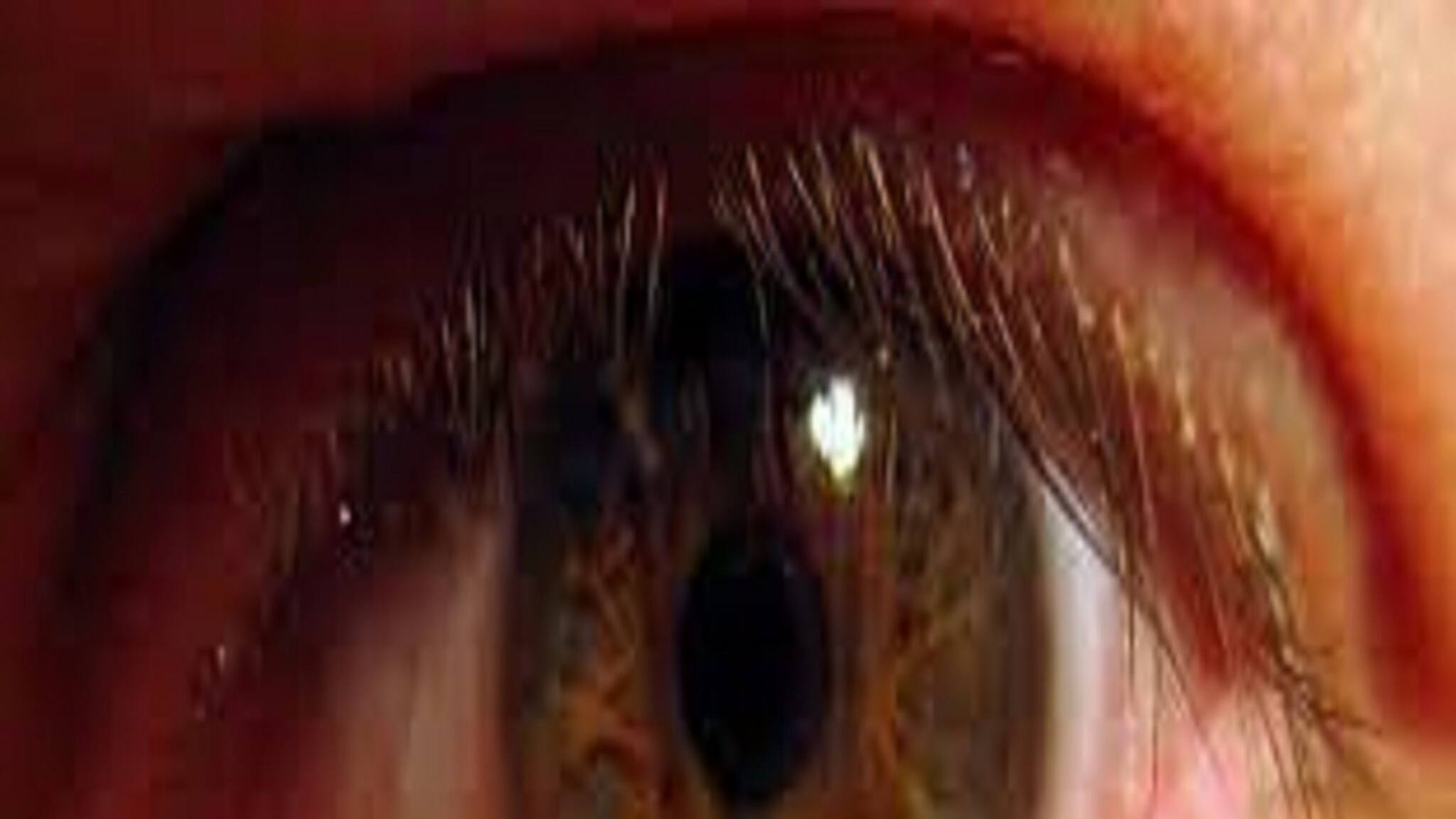 Conjunctivitis: লাল চোখের দিকে তাকালেই হবে কনজাংটিভিটিস? জানুন চিকিৎসকের মত