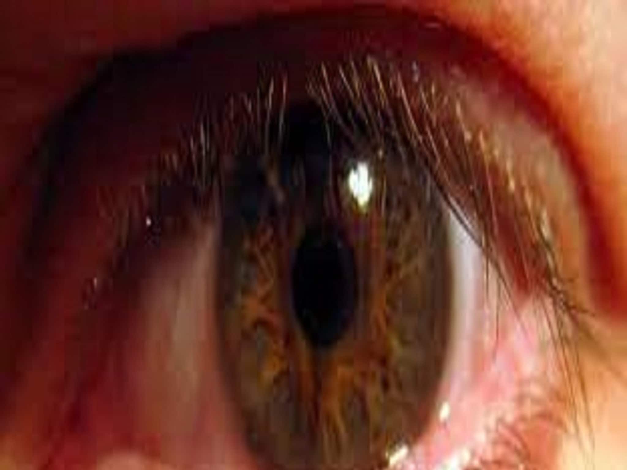 Conjunctivitis: লাল চোখের দিকে তাকালেই হবে কনজাংটিভিটিস? জানুন চিকিৎসকের মত