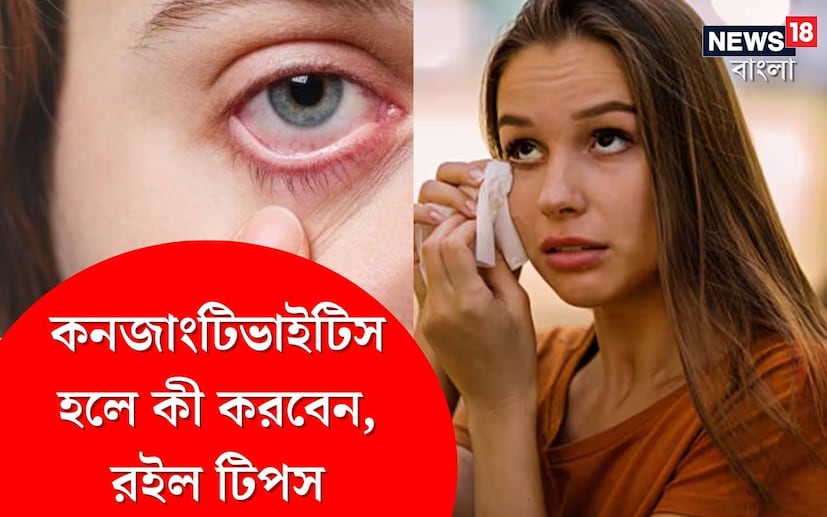  বর্ষার মরশুমে বৃষ্টির দাপট বাড়তে না বাড়তেই চোখের সংক্রমণে ভুগতে শুরু করেছে মানুষ। গ্রাম-শহর নির্বিশেষে ছড়িয়ে পড়ছে আই ফ্লু বা কনজাংটিভাইটিস। শহরের চক্ষু বিশেষজ্ঞদের ক্লিনিকে কনজাংটিভাইটিস নিয়ে ভিড় জমাচ্ছে প্রচুর মানুষ। শোনা যাচ্ছে, চোখের ক্লিনিকে আসা সমস্ত রোগীদের মধ্যে ৩০ থেকে ৪০ শতাংশই কনজাংটিভাইটিসে আক্রান্ত। এর মধ্যে অবশ্য শিশুর সংখ্যাই বেশি। 