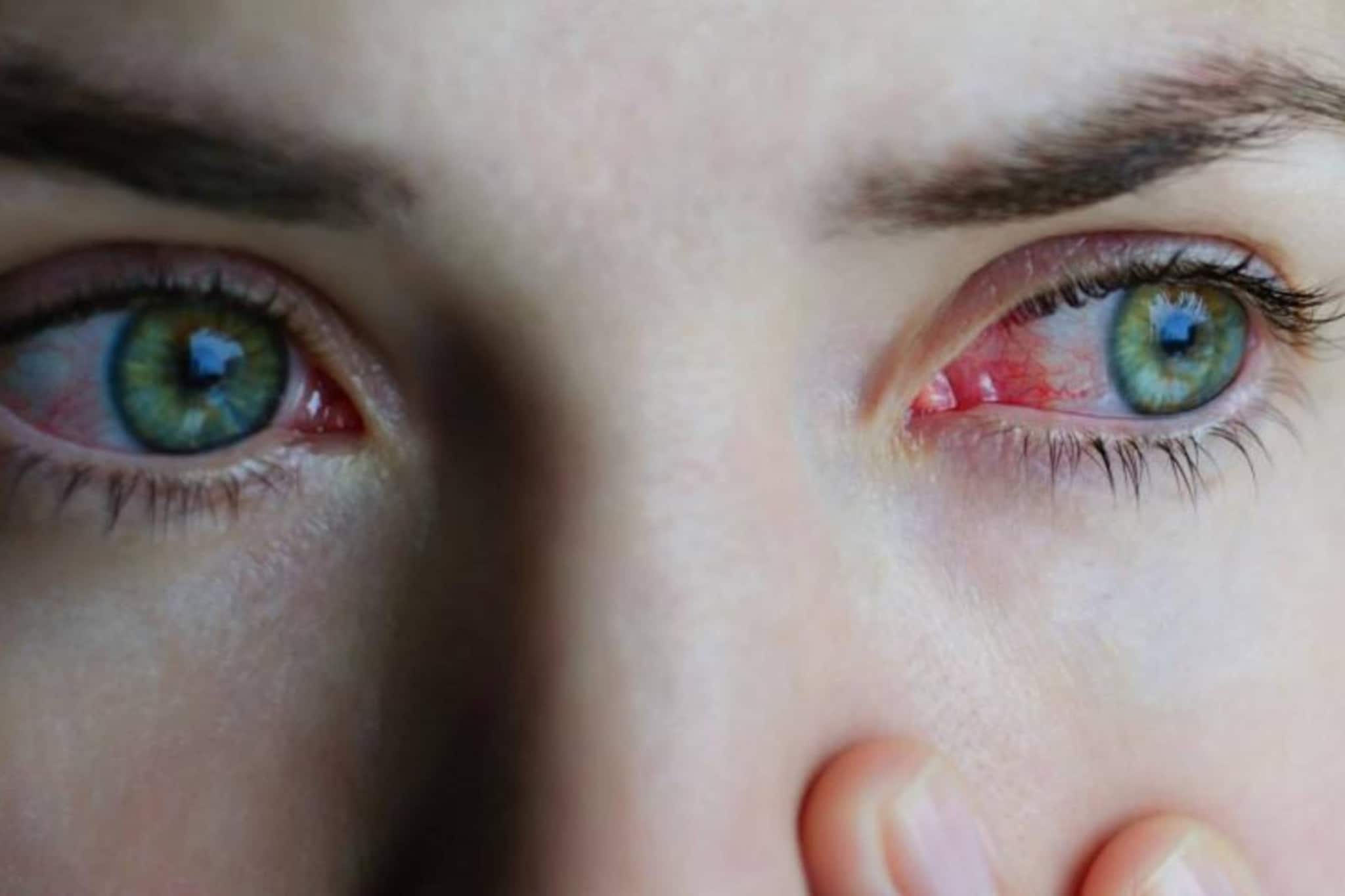 কনজাঙ্কটিভাইটিস এখন ‘মহামারি’! বাড়বে সংক্রমণ! মহিলাদের জন্য বিশেষ সতর্কতা