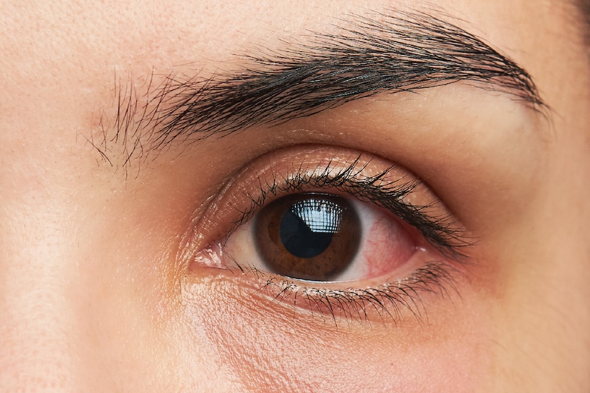 Conjunctivitis হলে, বেশিক্ষণ টিভি দেখা বা কম্পিউটারে কাজ করা উচিত নয়৷ উচিত নয় ফোন ঘাঁটাও৷
