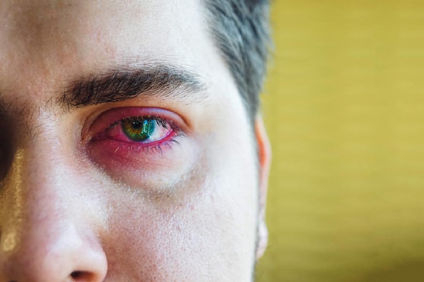 বর্তমানে Conjunctivitis-এর প্রকোপ বেড়েছে পশ্চিমবঙ্গে৷ প্রথমেই যে কথা জেনে রাখা দরকার, এই রোগ কিন্তু বেশ ছোঁয়াচে৷ বিশেষ করে স্কুলে যাওয়া ছোট বাচ্চাদের মায়েদের কিন্তু, অত্যন্ত সতর্ক হওয়া উচিত এ বিষয়ে৷