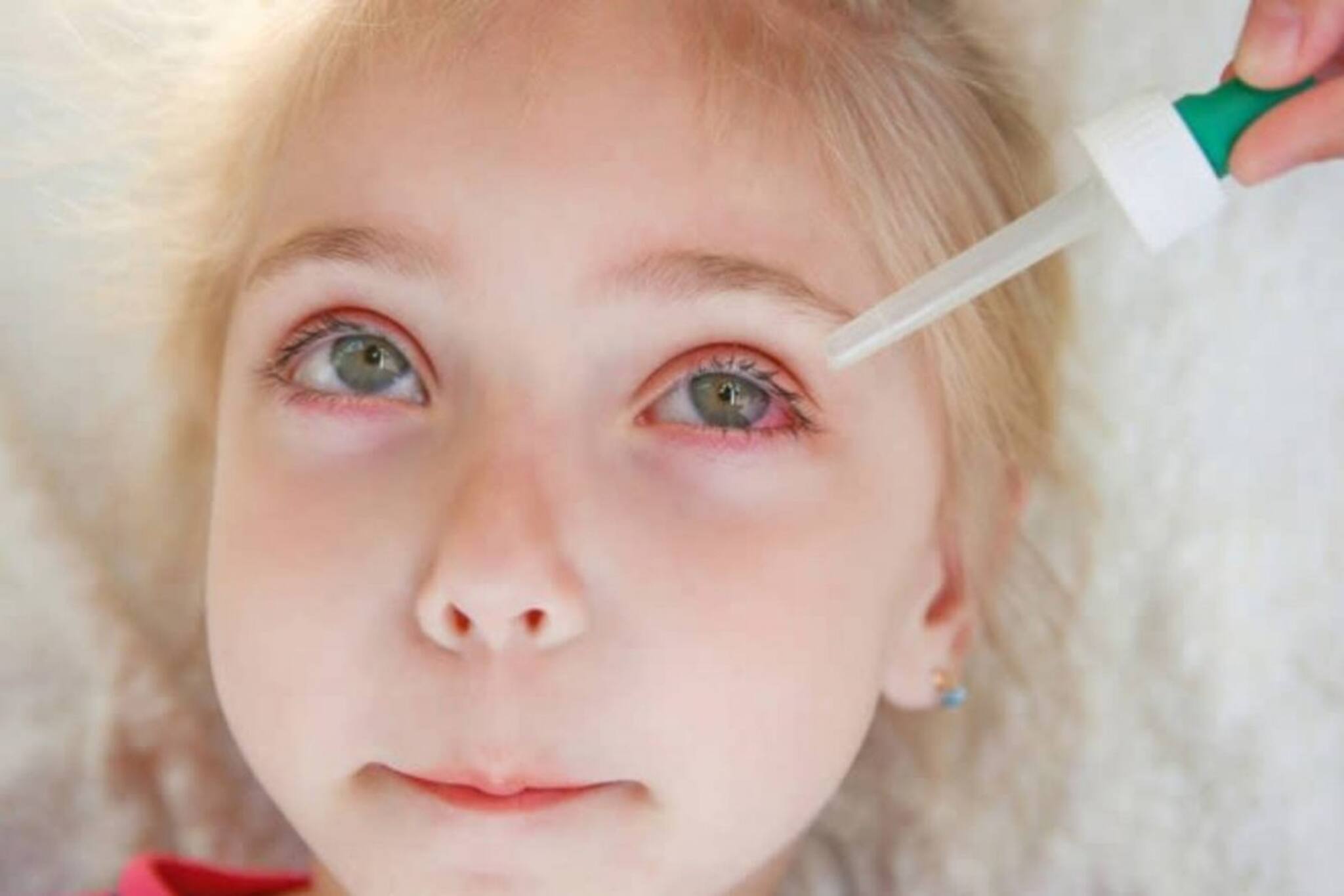 সন্তানের চোখে কনজাঙ্কটিভাইটিস? জানুন কখন চিকিৎসকের পরামর্শ নিতেই হবে এই সংক্রমণে