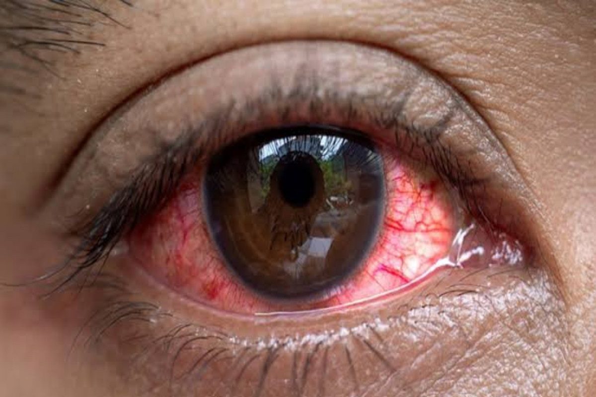 দ্রুত ছড়াচ্ছে কনজাংটিভাইটিস! কী করবেন, জেনে নিন বিশেষজ্ঞের কাছ থেকে দ্রুত ছড়াচ্ছে কনজাংটিভাইটিস! কী করবেন, জেনে নিন বিশেষজ্ঞের কাছ থেকে