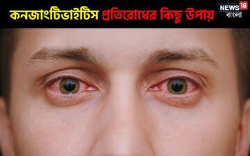 জবাফুলের মতো লাল চোখ নিয়ে ভিড় ডাক্তারখানায়; রইল কনজাংটিভাইটিস প্রতিরোধের উপায়