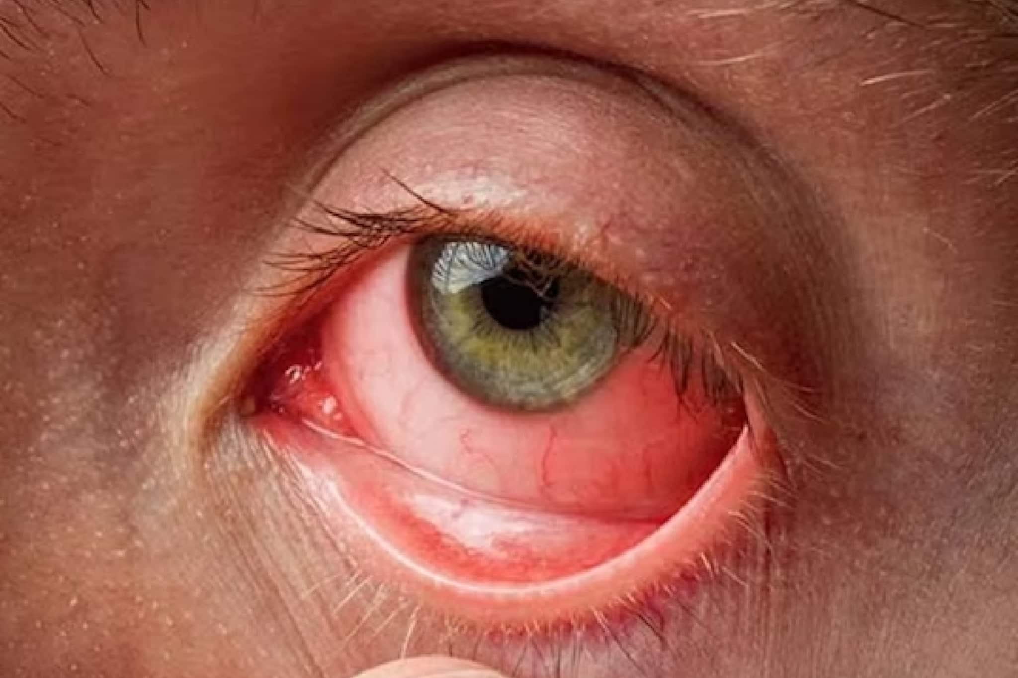Conjunctivitis Eye Flu: কনজাংটিভাইটিসের ভয়ে কাঁপছে গোটা দেশ! KGMU-এর নির্দেশিকা জারি, নিজেকে সুরক্ষিত রাখুন এভাবে