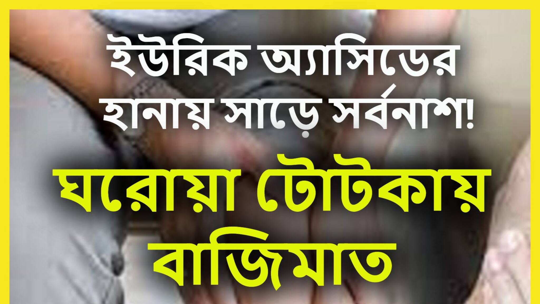 High Uric Acid: ইউরিক অ্যাসিডের ভয়ঙ্কর রূপে গাঁটের ব্যাথা-হাড়ের ব্যাথা, সারা শরীরে যন্ত্রণা, এড়িয়ে গেলেই গম্ভীর পরিণতি