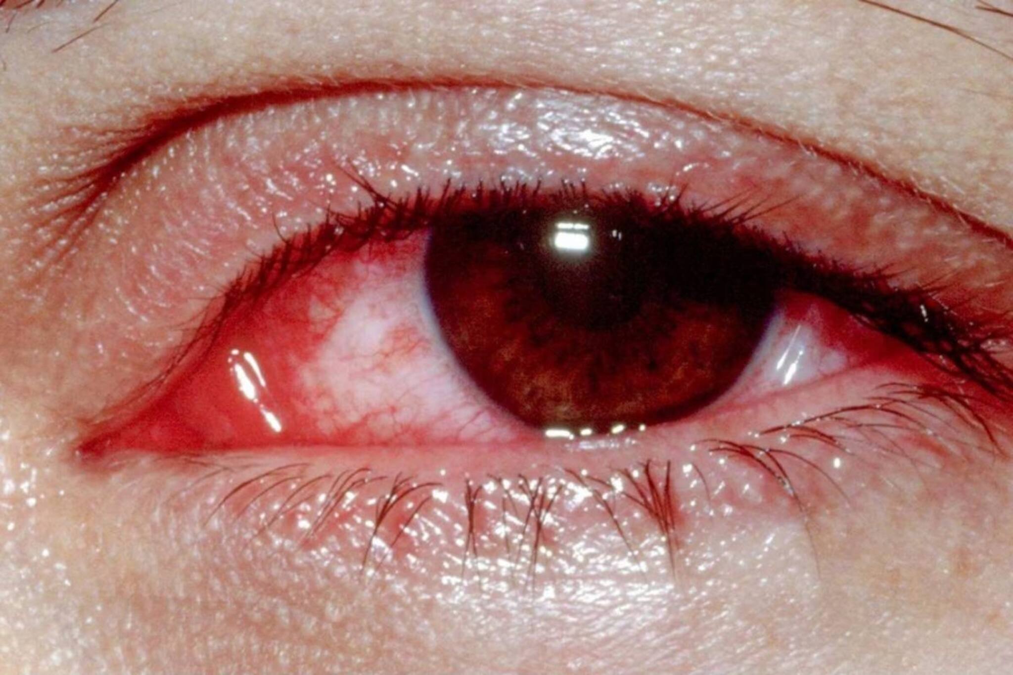 কনজাংটিভাইটিস এড়াতে চান? এই মিশ্রণে চোখ ধুলেই সংক্রমণ থেকে মিলবে সুরক্ষা