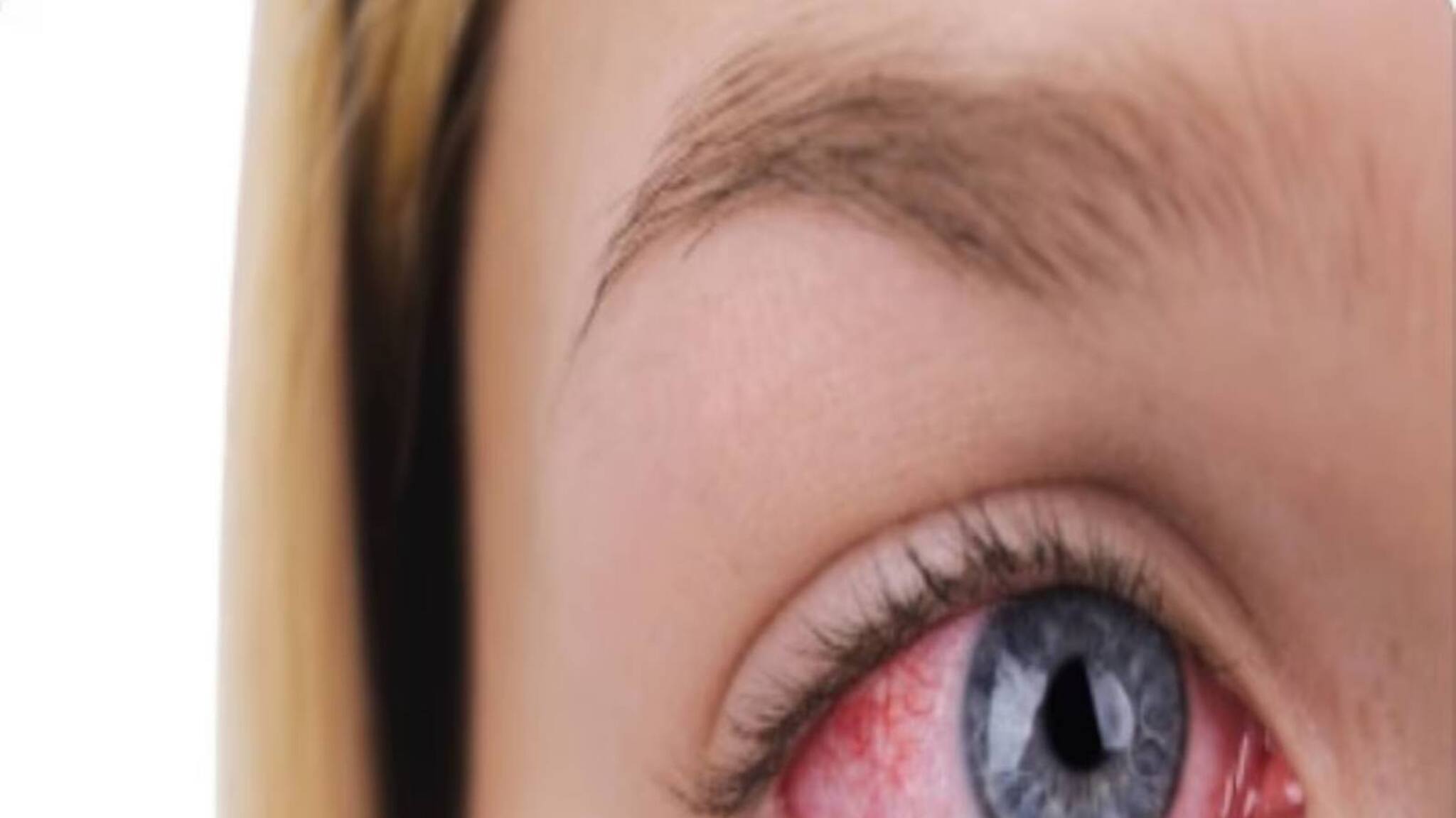 Conjunctivitis Diet: কনজাংটিভাইটিস হলে খান এই খাবারগুলি! সংক্রমণ সেরে জলদি আরাম যন্ত্রণা থেকে