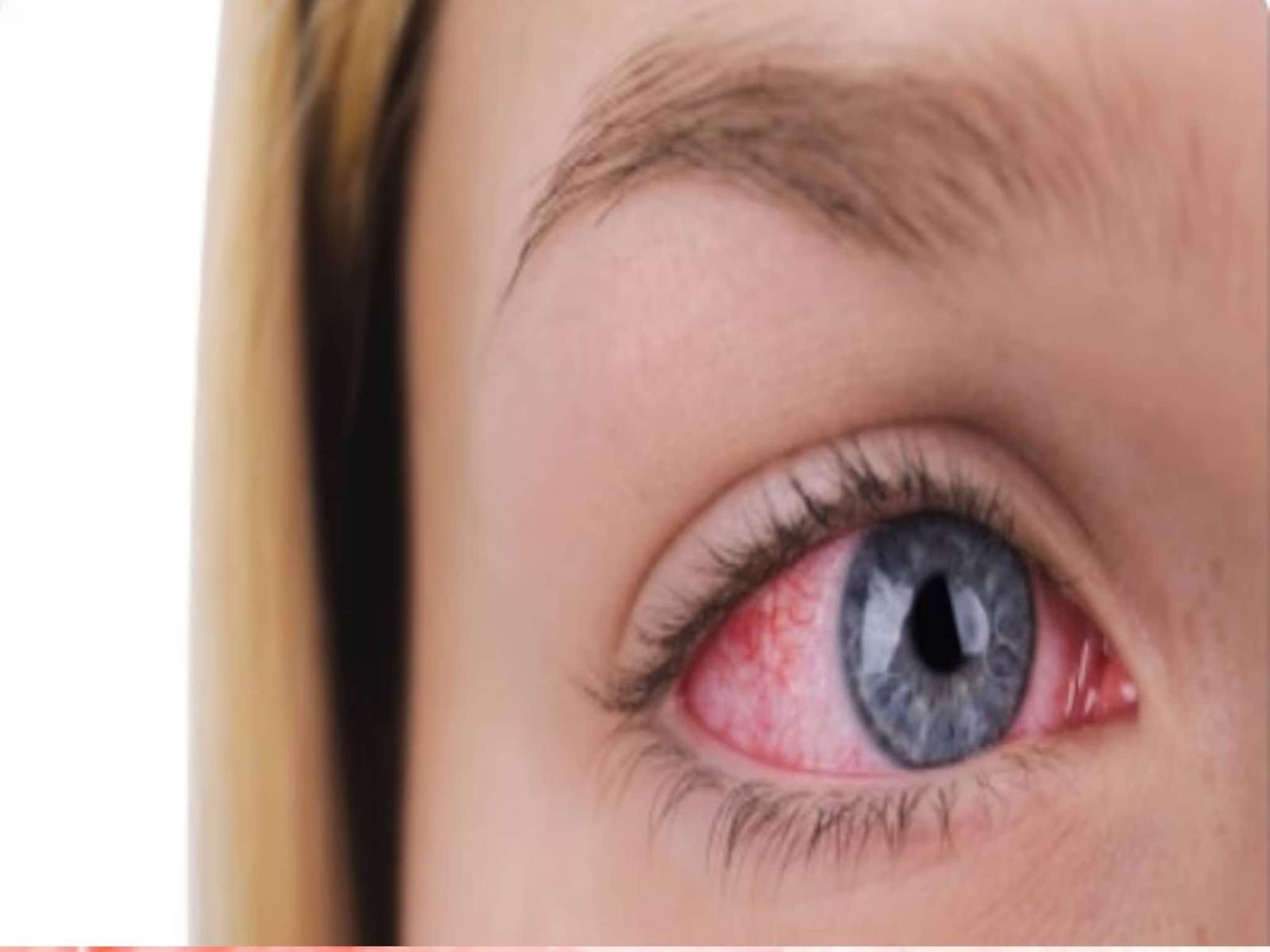 Conjunctivitis Diet: কনজাংটিভাইটিস হলে খান এই খাবারগুলি! সংক্রমণ সেরে জলদি আরাম যন্ত্রণা থেকে