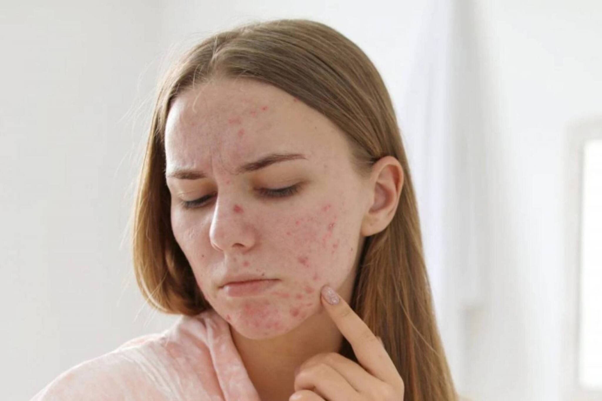 ব্রণ, অ্যাকনের দাপটে ক্ষত বিক্ষত মুখ? রোজ সকালে খান এই পানীয়,  উপকার পাবেনই