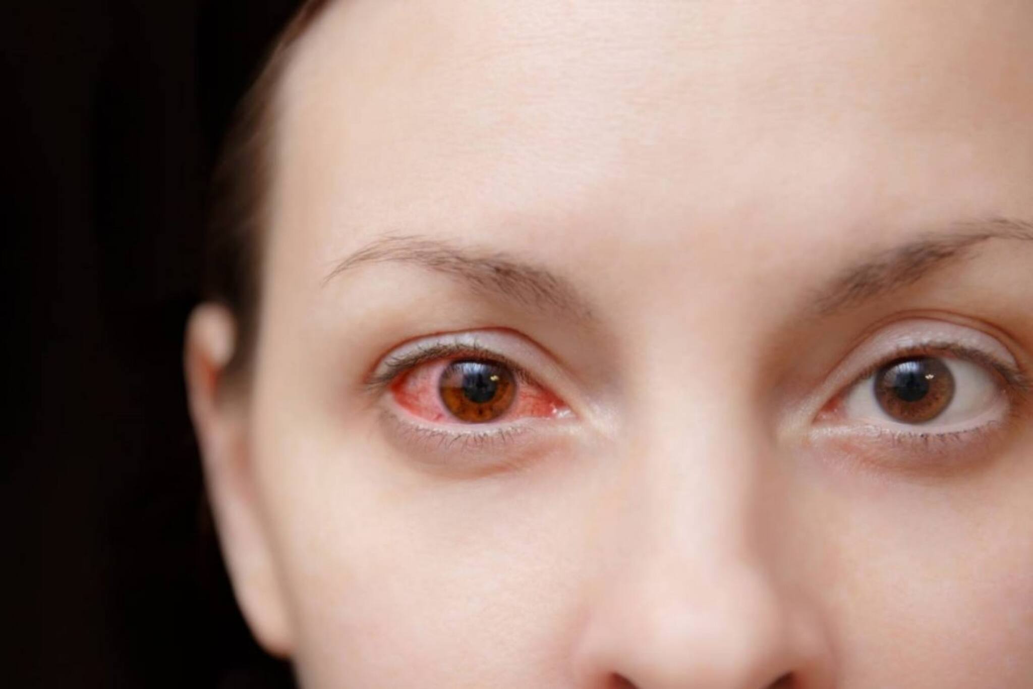 কনজাংটিভাইটিস হলে রোদচশমা পরে বাইরে যাওয়া কি নিরাপদ? কী বলছেন ডাক্তার? জানুন