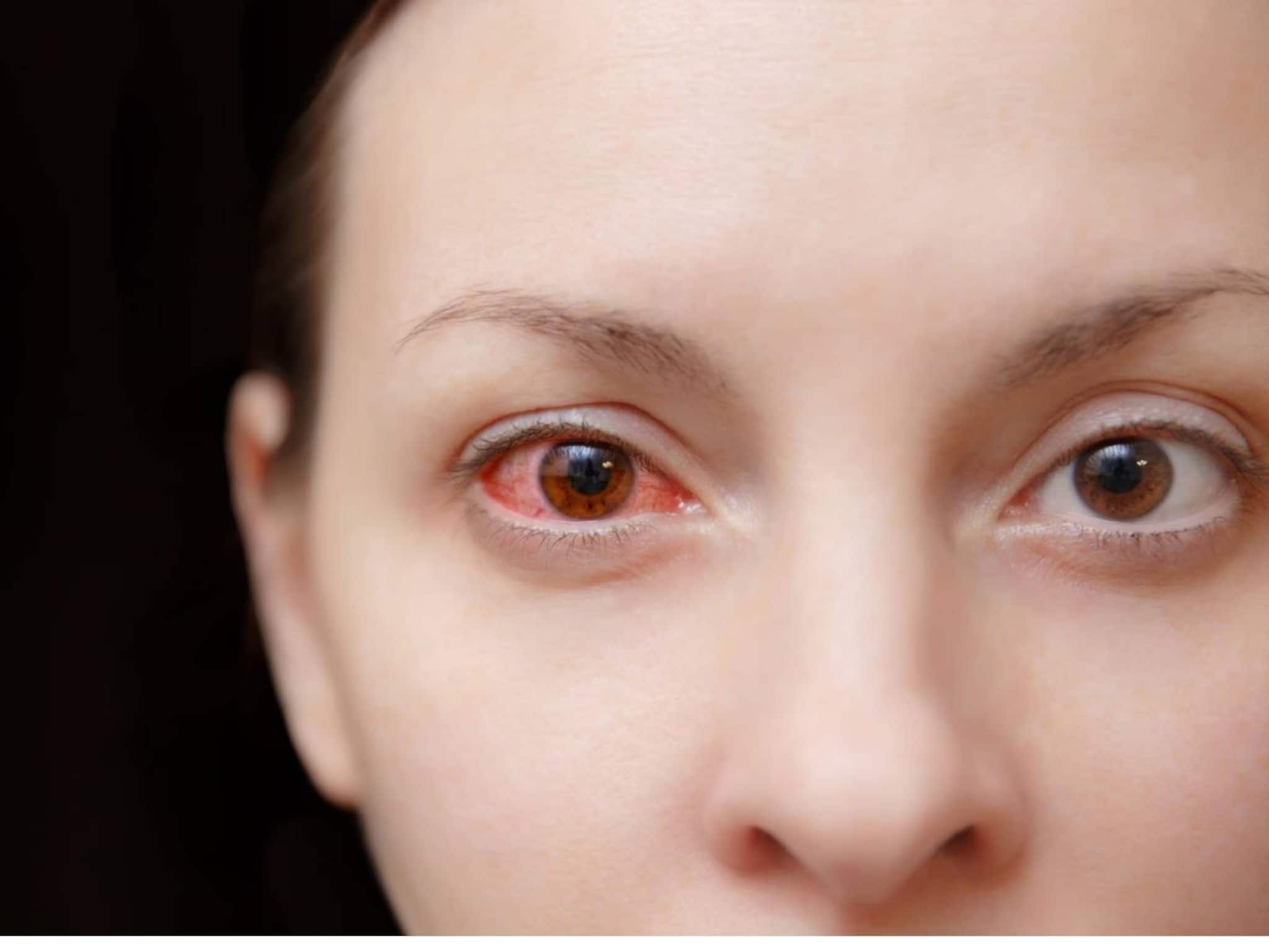 Eye Specialist's Interview on Conjunctivitis: কনজাংটিভাইটিস হলে রোদচশমা পরে বাইরে বার হওয়া কি নিরাপদ? কী বলছেন চক্ষু বিশেষজ্ঞ? জানুন