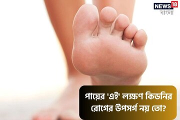 আপনার শরীরে কি Kidney-র রোগ বাসা বাঁধছে? বুঝে নিন 'এই' লক্ষণ দেখে!
