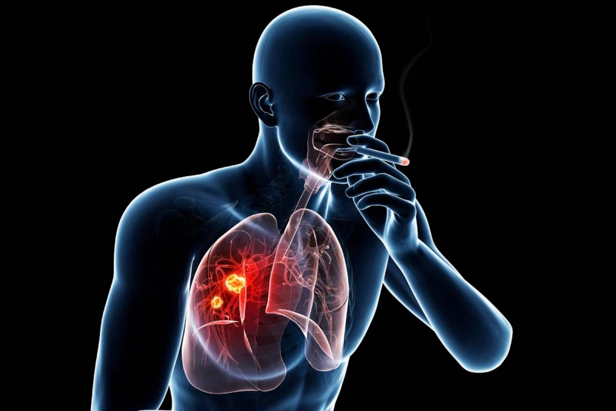 যুবদের ফুসফুসের ক্যানসারের ঝুঁকি বাড়ছে ৫ গুণ! নেপথ্যে তামাক? কী বলছেন চিকিৎসকরা