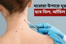 দূর হবে তিল হোক বা আঁচিল! ঘরোয়া উপায় বাতলে দিলেন আয়ুর্বেদাচার্য