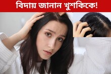দামি শ‍্যাম্পুও ফেল! খুশকি কমাতে কাজে লাগান এই টোটকা, ফল পাবেন হাতেনাতে
