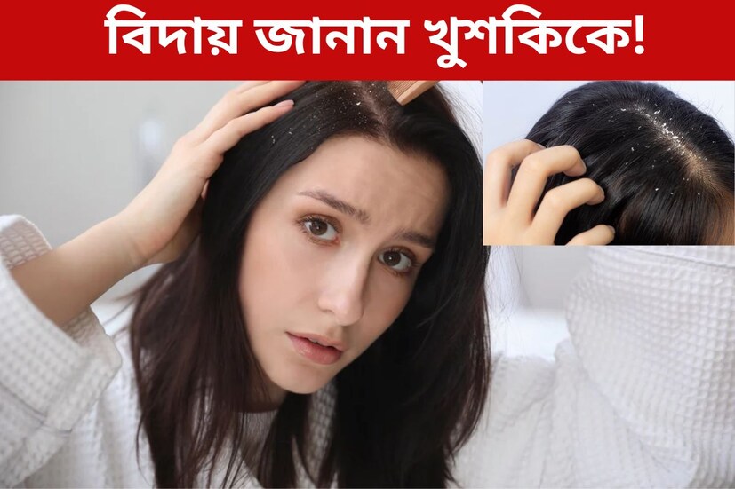 চুল পড়ার একটি বড় কারণ হল খুশকি। দামি দামি খুশকি বিনাশকারী শ‍্যাম্পুতেও বেশিরভাগ সময় কোনও কাজ হয়না। মাথার ত্বকে থেকেই যায় সাদা সাদা অদ্ভুত দর্শন এই ছত্রাক। চুলে চিরুনি পড়লেই ঝরে পড়ে সাদা সাদা গুঁড়োর মতো খুশকি। চুল পড়া তো বটেই, পাশাপাশি মাথায় চুলকানির মতো সমস‍্যাও আসতে পারে খুশকি থেকে। সেইসঙ্গে জামাকাপড় থেকে ত্বক, সৌন্দর্যের দফারফা করে বিরক্তিকর খুশকি। 