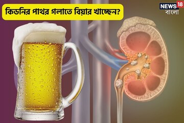 কিডনির পাথর গলাতে ঘনঘন বিয়ার খাচ্ছেন? ক্ষতি হচ্ছে না তো?  কী বলছেন চিকিৎসক?