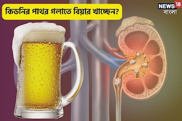 কিডনির পাথর গলাতে ঘনঘন বিয়ার খাচ্ছেন? ক্ষতি হচ্ছে না তো? কী বলছেন চিকিৎসক? কিডনির পাথর গলাতে ঘনঘন বিয়ার খাচ্ছেন? ক্ষতি হচ্ছে না তো? কী বলছেন চিকিৎসক?
