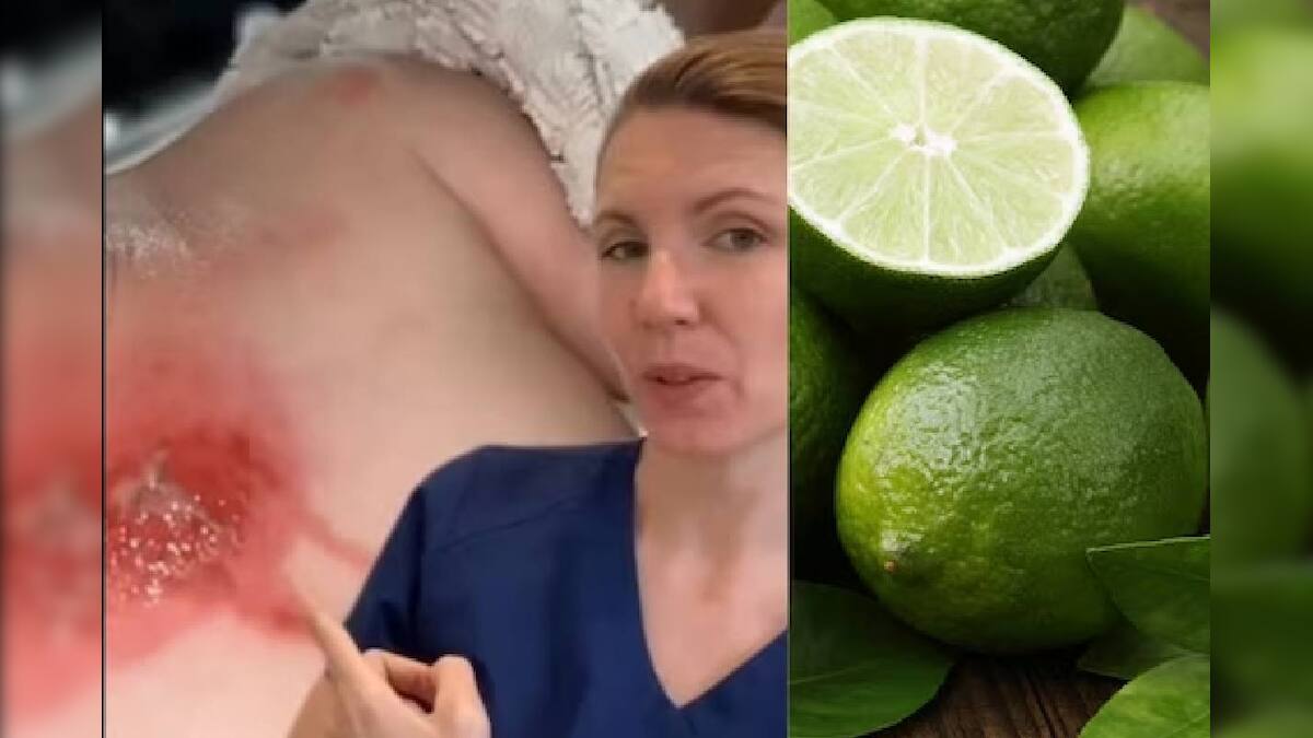 Lemons in SunlightPhytophoto Dermatitis সূর্যের আলোয় ভুলেও খাবেন না