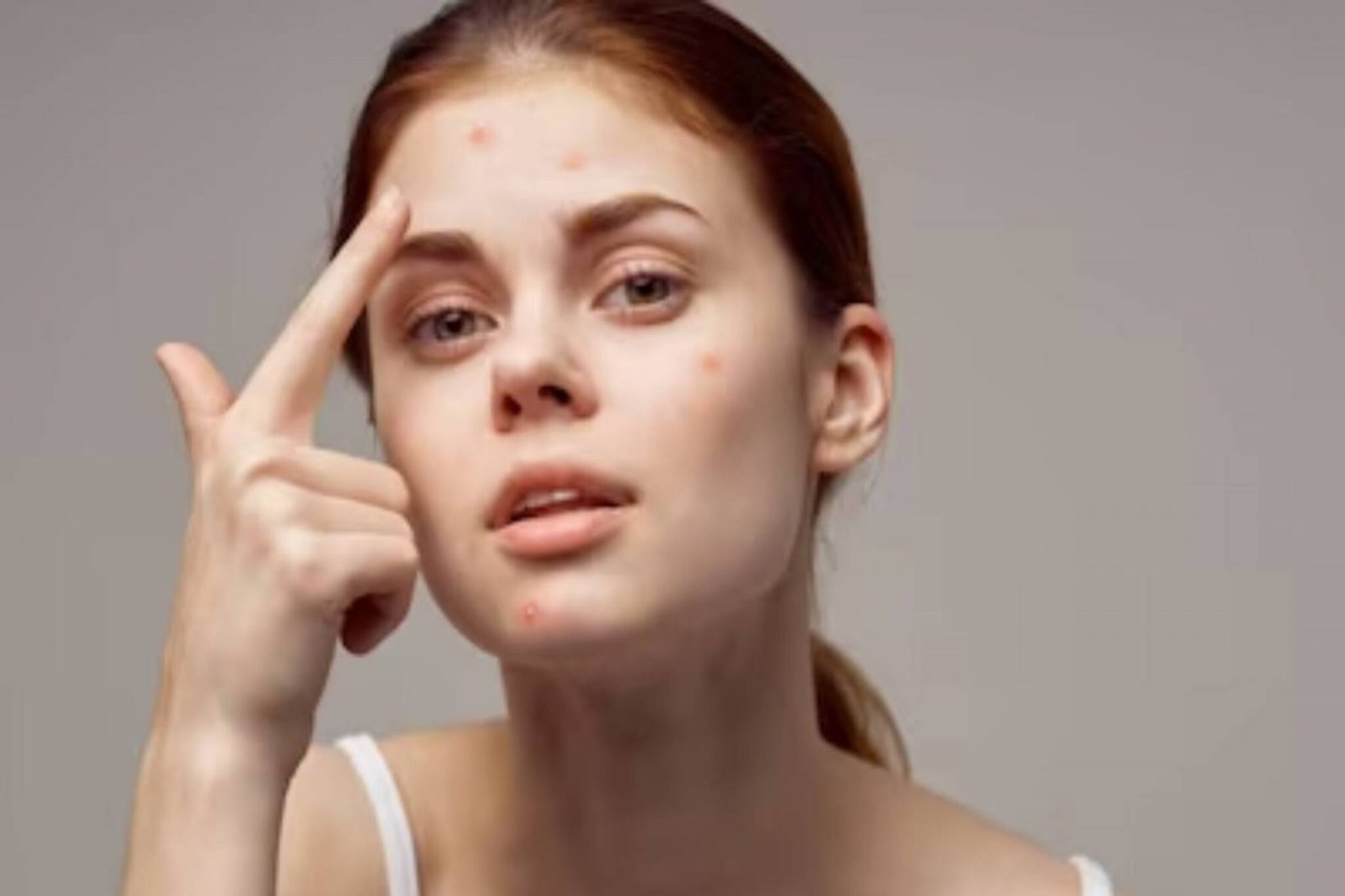 পুজোর সাজগোজের পরে ত্বকে ব্রণর দাগ? দূর করুন এই ঘরোয়া উপায়ে