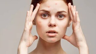 মুখে ব্রণ বা অ্যাকনে হলে পুজোর সাজই মাটি