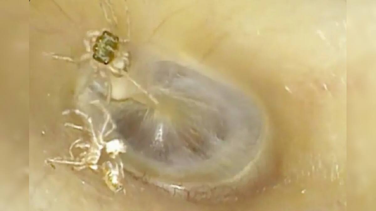 কান চুলকায়, আওয়াজ হয়? সাবধান! বৃদ্ধার কানের ভিতর থেকে উদ্ধার ভয়ঙ্কর জিনিস কান চুলকায়, আওয়াজ হয়? সাবধান! বৃদ্ধার কানের ভিতর থেকে উদ্ধার ভয়ঙ্কর জিনিস