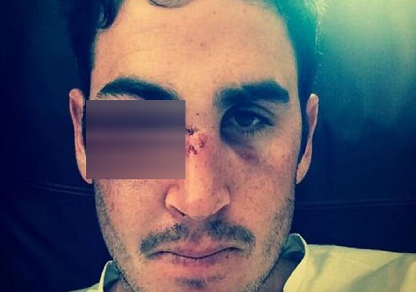 সেই চোট তাঁর কেরিয়ার শেষ করে দেয়। তিনি তার পর আর বেশিদিন খেলতে পারেননি। 