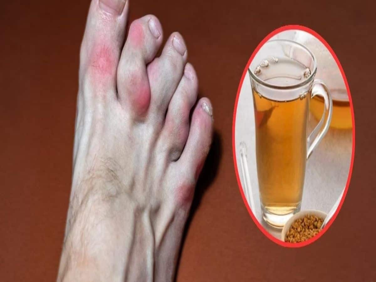 Uric Acid Control Tips ওষুধ ছাড়াই কমবে ইউরিক অ্যাসিড! ওজন কমাতেও