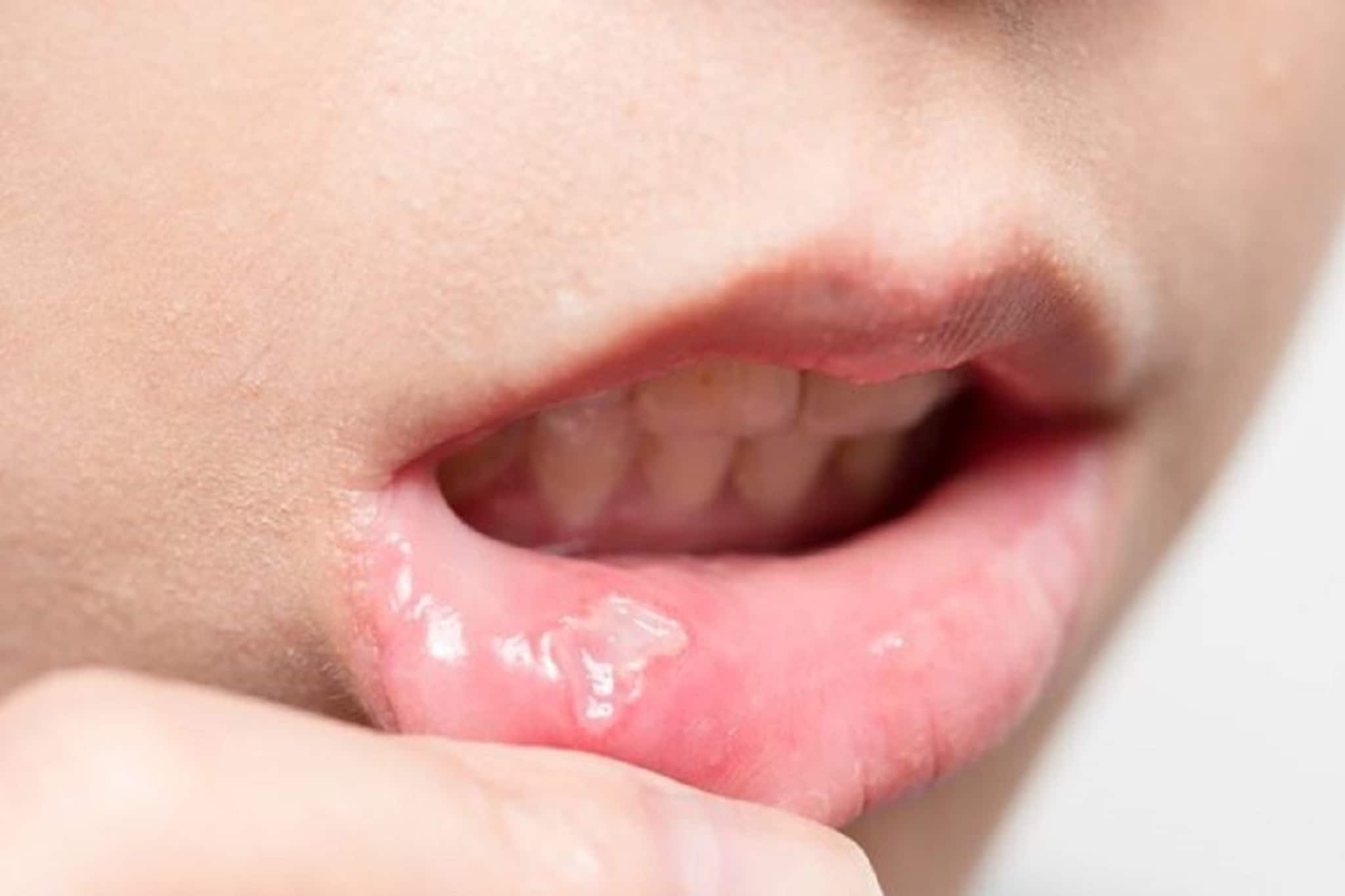 মুখে আচমকাই ছোট ফুসকুড়ি, লাল দাগ! ক্যানসার নয় তো? 'এই' লক্ষণ দেখলেই সাবধান