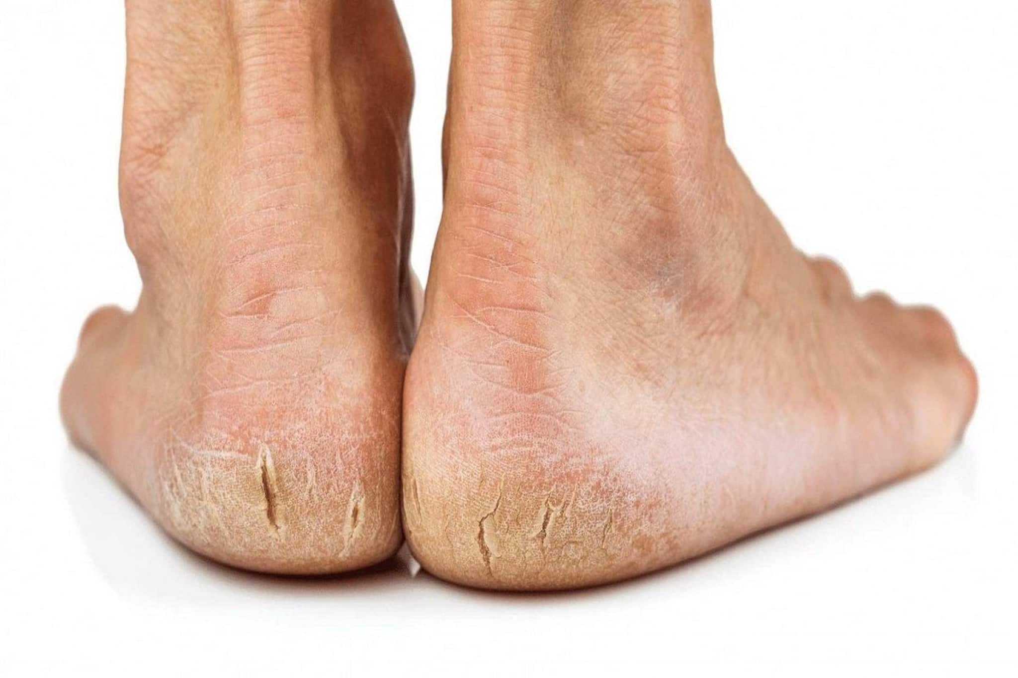 রান্না ঘরের এই মশলাতে রাতারাতি দূর হবে ফাটা গোড়ালি! জানুন কী করতে হবে