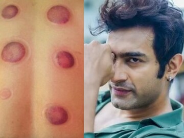 সারা পিঠে চাকা চাকা জমাট বাঁধা রক্ত! বালিশে মুখ গুঁজে কী করছেন জিতু? ছবি ভাইরাল