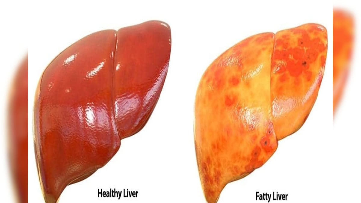 fatty-liver-disease