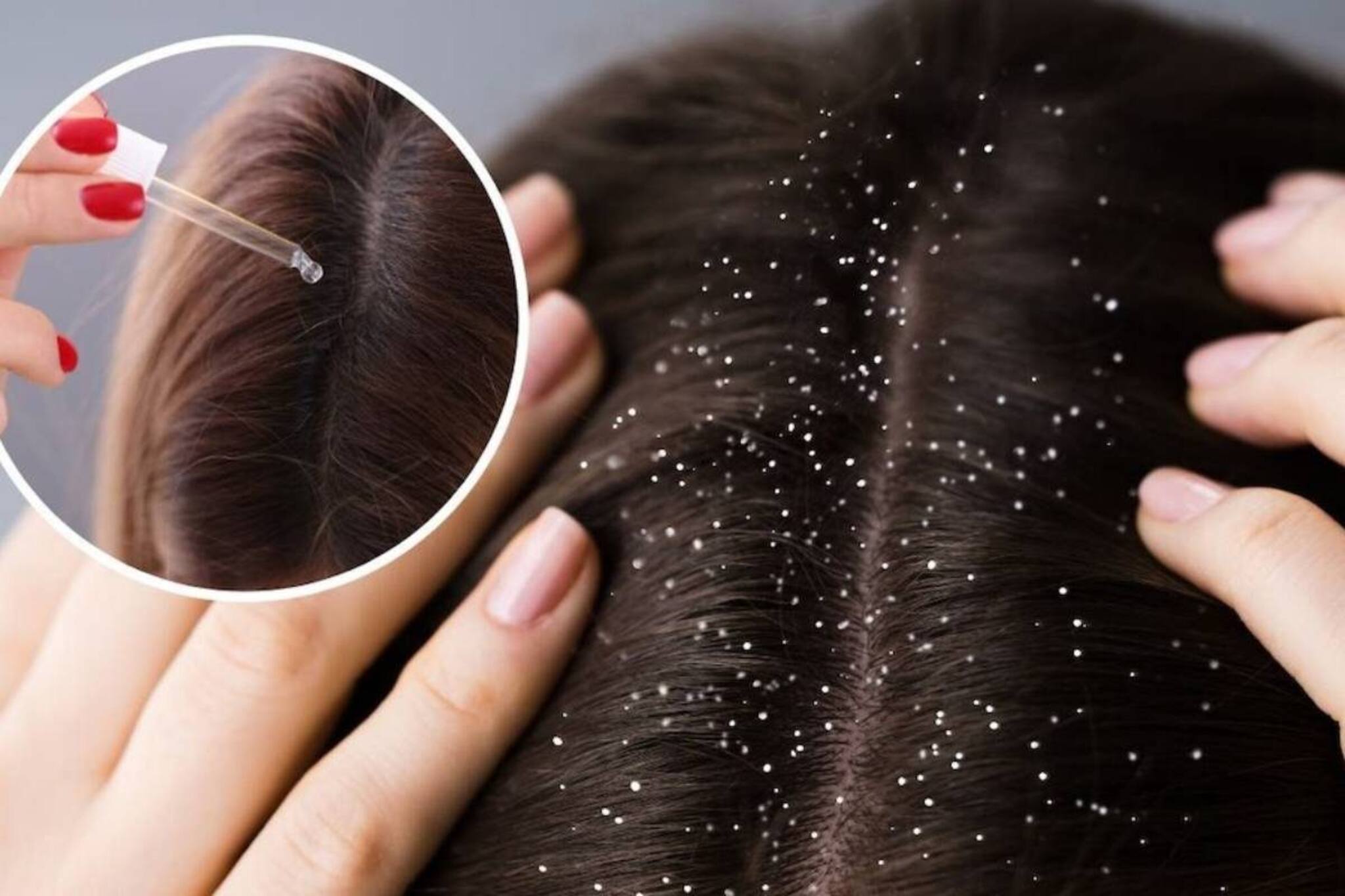 পার্লারের স্পা-তেও কমল না খুশকি? এই ঘরোয়া টোটকা কাজে লাগিয়ে দেখুন...ফল পাবেন