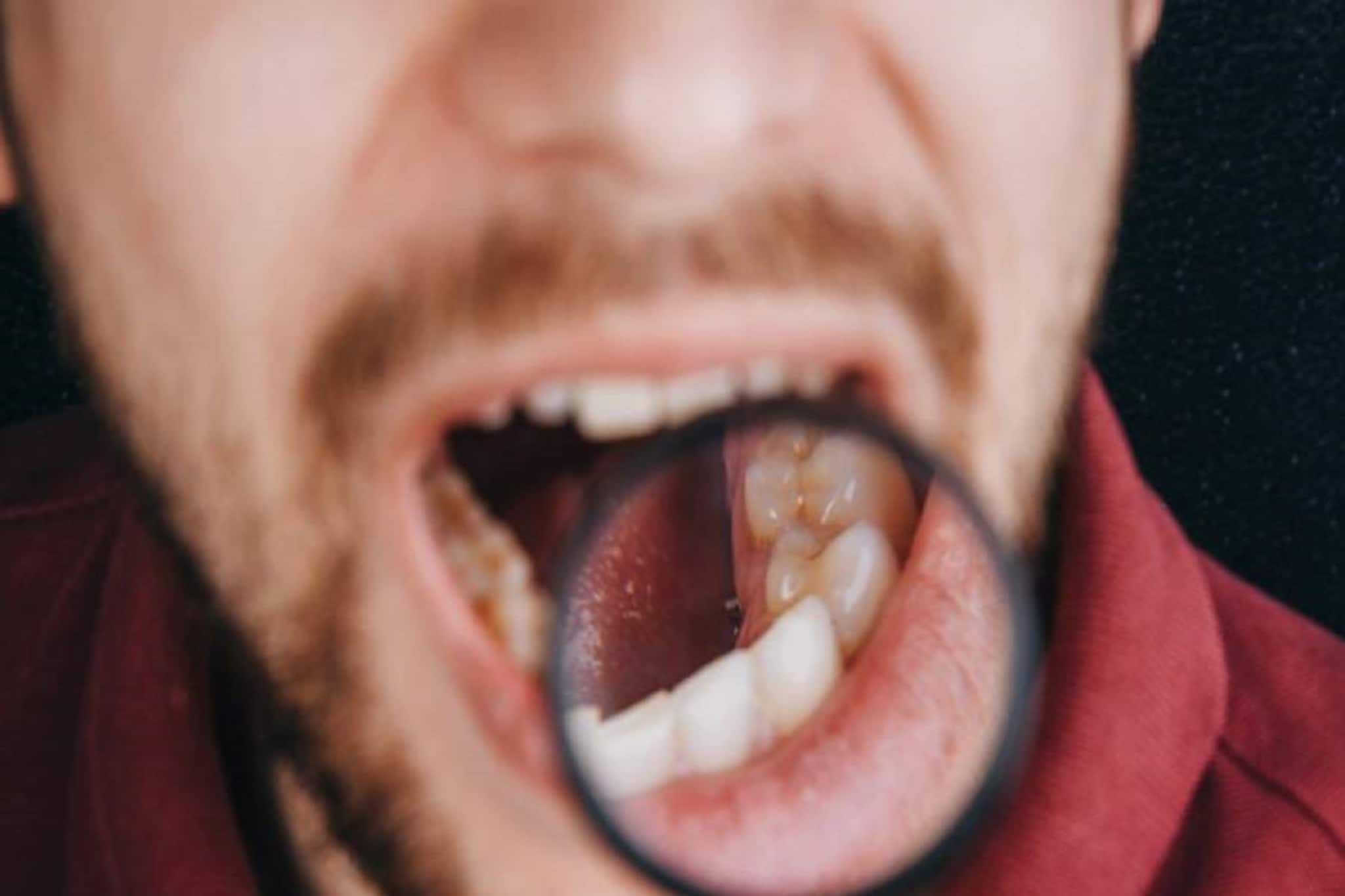 সিগারেট খান? কোন উপসর্গ দেখলে বুঝবেন মুখে ক্যানসার বাসা বেঁধেছে, জানুন