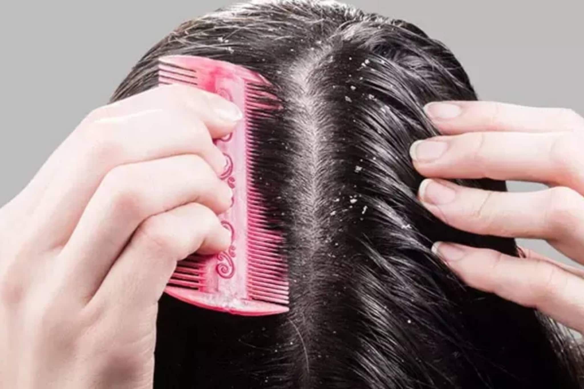 শীতে খুশকির সমস্যা বাড়ছে? আপনার ছোট্ট কয়েকটা ভুলেই ক্ষতি হচ্ছে! দেখুন এক নজরে