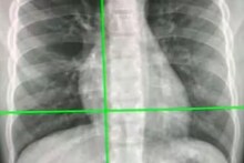 এখন বুকের X-ray দিয়ে কোভিড পরীক্ষা! নতুন ব্যবস্থায় ৯০ শতাংশ কার্যকরীতা