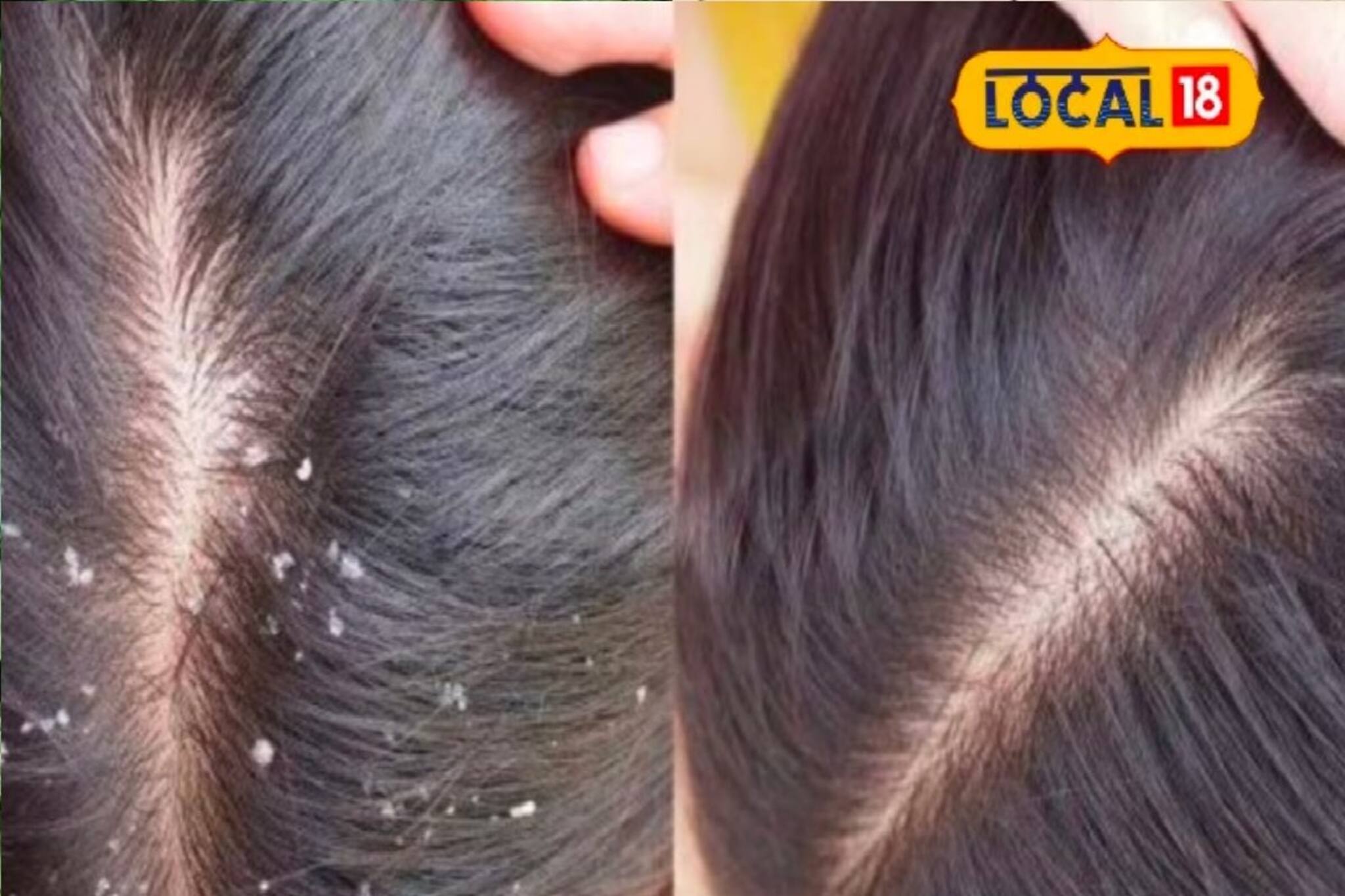 শীত এলেই মাথা ভর্তি খুশকি! ভয়ঙ্কর ক্ষতি হয়ে চলেছে রোজ! ৫ টাকাতেই মিরাকল