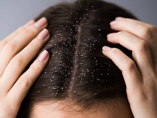শীতকালে বিশেষ করে চুলে খুশকির সমস্যা দেখা যায়