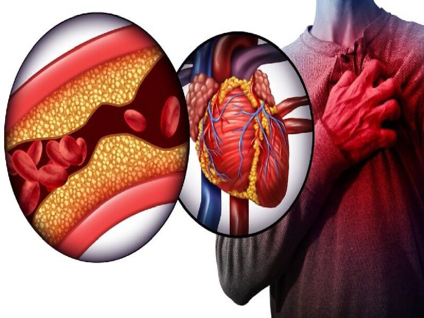 ১৯ বছর বা তার কম বয়সিদের জন্য LDL cholesterol থাকা উচিত ১১০ mg/dL এর নীচে৷ ১১০-১২৯ হলে তা বর্ডারলাইন এবং ১৩০ এর বেশি হলে হাই৷