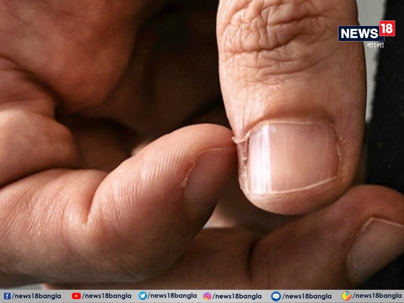 আপনার আঙুলে নখের পাশের চামড়া যদি প্রায়ই উঠে আসে, তবে তা আপনার মনে হতে পারে যে খুব স্বাভাবিক ঘটনা। শীতকালে এই প্রবণতা আরও বাড়ে। তবে এই সাধারণ ঘটনাটি প্রায়শই বেশ বিরক্তির কারণ তৈরি করে। কারণ নখের পাশের চামড়া উঠলে বেশ ব্যথা লাগে, সেই ব্যথা বেশ কয়েকদিন থাকেও। ফলে কাজকর্ম করতে সমস্যায় পড়তে হয়। (Disclaimer: এই প্রতিবেদনটি কেবলমাত্র সাধারণ তথ্যের জন্য, তাই বিস্তারিত জানতে হলে সর্বদা বিশেষজ্ঞের পরামর্শ নিন।)