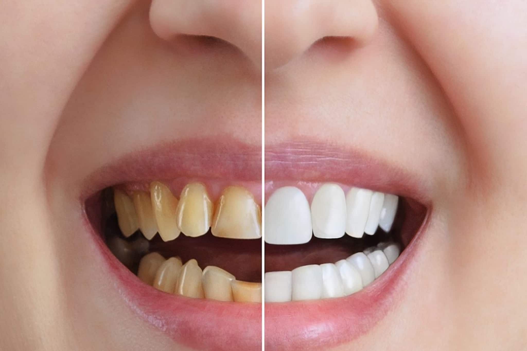 নামীদামি পেস্ট ব্যবহার করেও দাঁত হলুদ? নিমেষে ঝকঝকে সাদা দাঁত পান এই ঘরোয়া উপায়ে