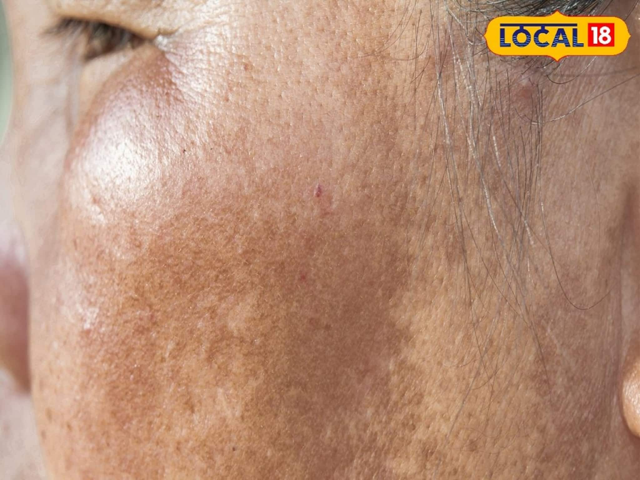Skin Black Spot: ঘরোয়া প্যাকেই দূর করুন হাত পায়ের কালো ছোপ দাগ