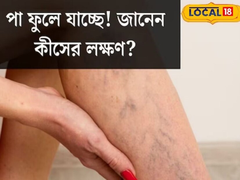 তাই যদি পা ফুলে যায় এবং পায়ে জল জমা হয় কোনও রকম উল্টোপাল্টা ওষুধ না খেয়ে ফিজিসিয়ান এর সঙ্গে পরামর্শ করা দরকার। এবং তিনি যেরকম পেস্ক্রাইব করবেন সেইরকমই ওষুধ খেতে হবে ।