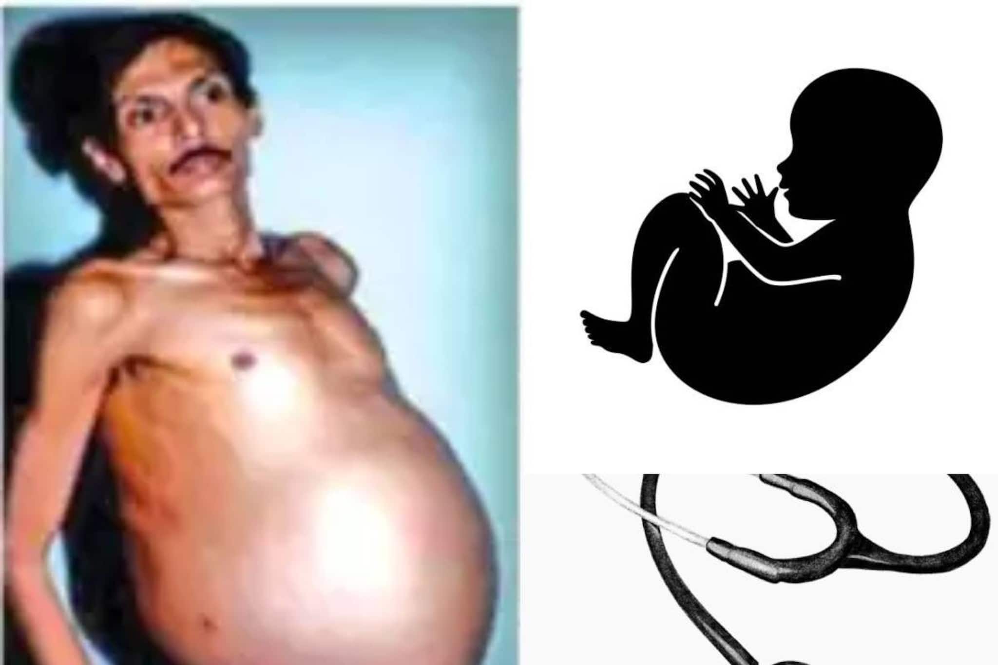 ‘গর্ভবতী তরুণের’ শরীরে বাড়ছে ‘সন্তান’! স্ফীত উদর নিয়ে ইনি ‘অন্তঃসত্ত্বা পুরুষ’