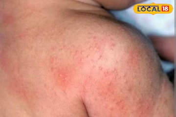 গরম মানেই বিরক্তিকর ঘামাচি, পাউডার নয়, ঘামাচি থেকে মুক্তি পান এই ঘরোয়া উপায়ে গরম মানেই বিরক্তিকর ঘামাচি, পাউডার নয়, ঘামাচি থেকে মুক্তি পান এই ঘরোয়া উপায়ে