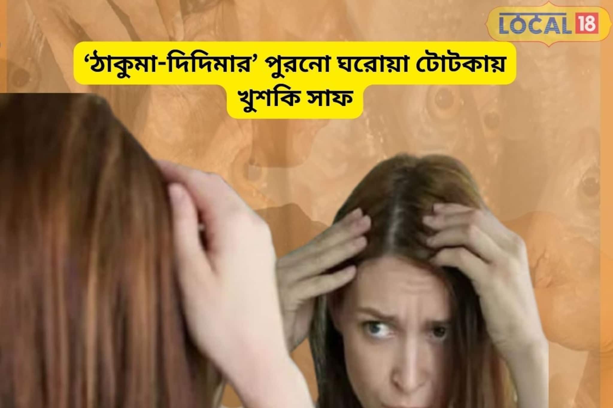 খুশকিতে চুল উঠে সাফ?পুরনো দিদিমা-ঠাকুমার আমলের ঘরোয়া উপায়ে পান লম্বা-ঘন চুল