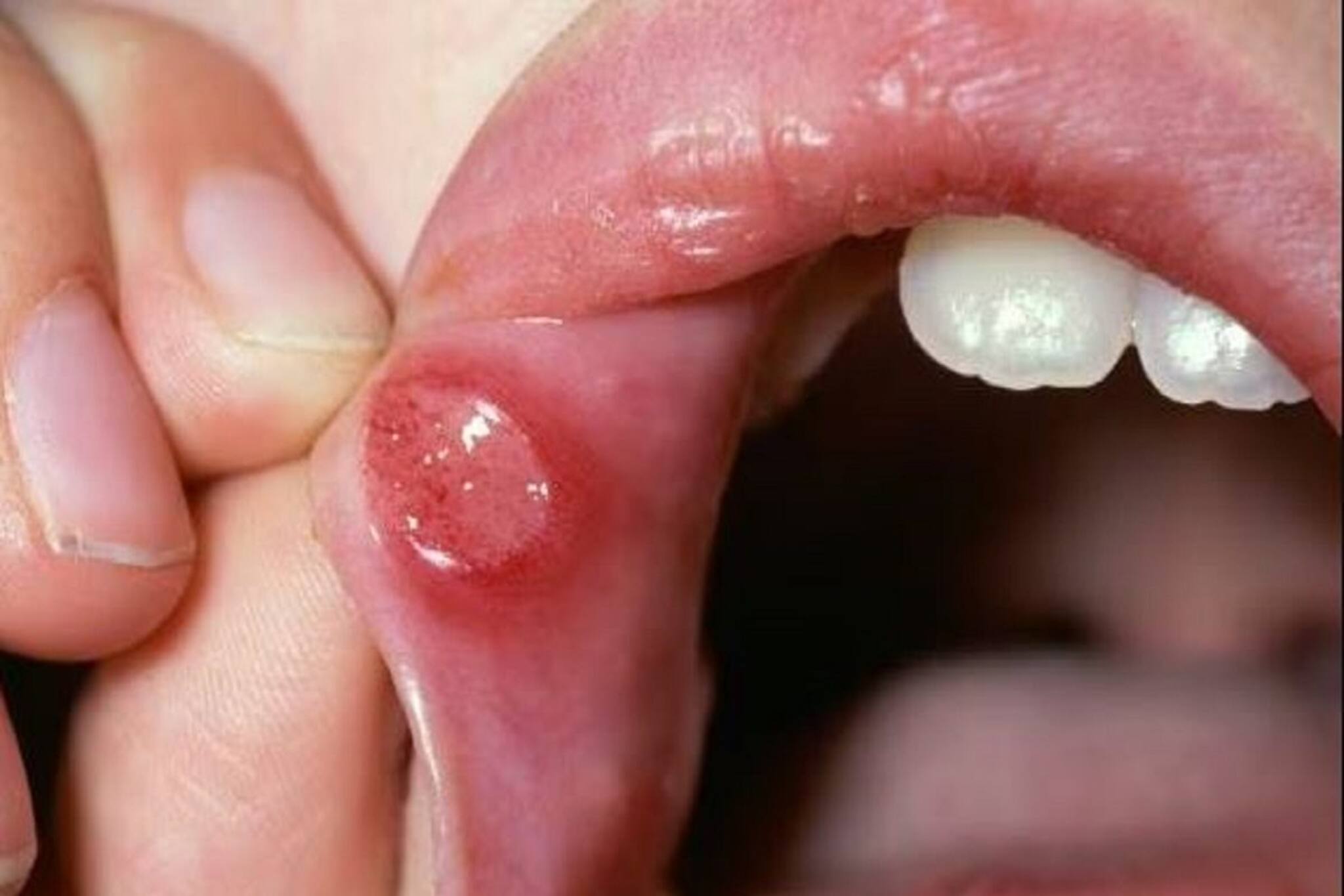 মুখের ঘা সারছে না? ঘরেই থাকে পাঁচটি মোক্ষম ওষুধ, ফল মিলবে হাতেনাতে